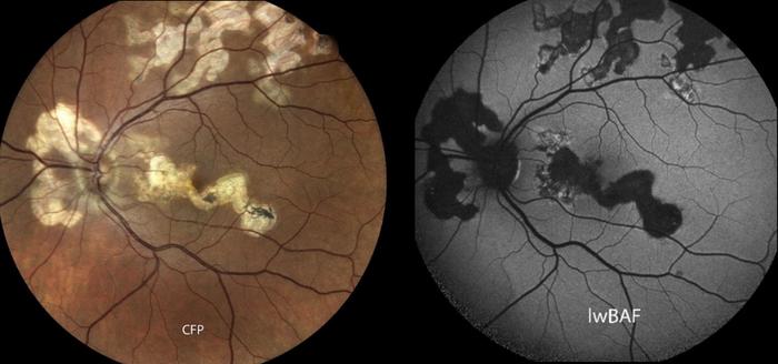 Fundus Autofluorescence: tecnica di imaging per le diagnosi di uveite