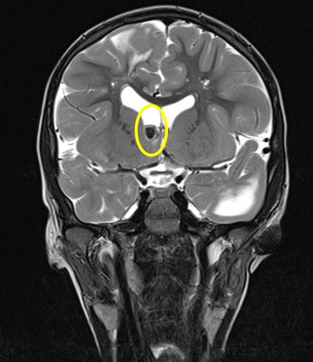 Oltre 150 i bambini e i ragazzi con sclerosi tuberosa assistiti al Bambino Gesù di Roma