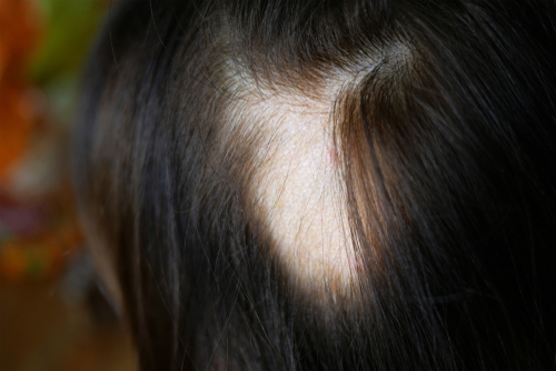 Depressione e alopecia areata, una minaccia per la qualità della vita