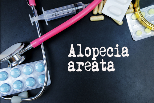 Nella gestione dell’alopecia aerata c’è molta necessità di innovazione