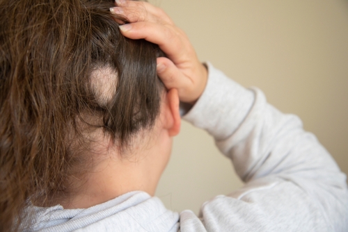 Alopecia areata: come i pazienti percepiscono una forma di malattia grave